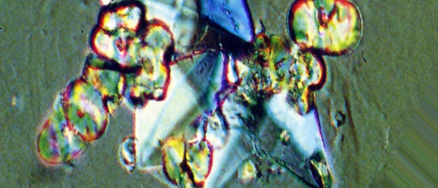 Calciumoxalatkristalle im Urin, 
Foto von Prof. Dr. med. R. Schindler, Charité